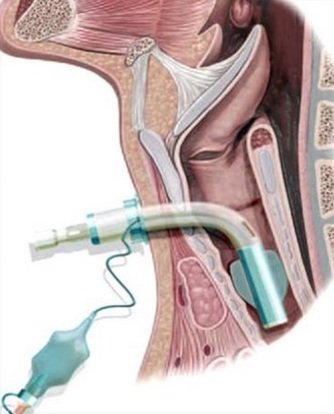 MANUAL DE CUIDADOS RESPIRATORIOS PARA FAMILIARES DE PACIENTES ADULTOS TRAQUEOSTOMIZADOS